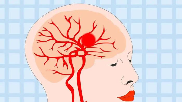 白医科普神经外科系列脑子里的不定时炸弹
